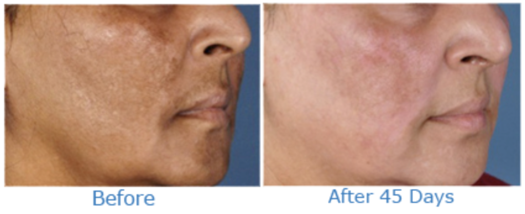 MELASMA TREATMENT