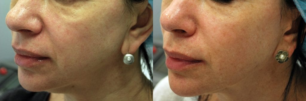 Before & After Image of Morpheus8 Treatment Austin TX