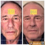 Before & After Image of Walden XO Biofacial Austin TX