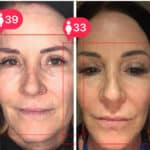 WaldenBefore & After Image of Walden XO Biofacial Austin