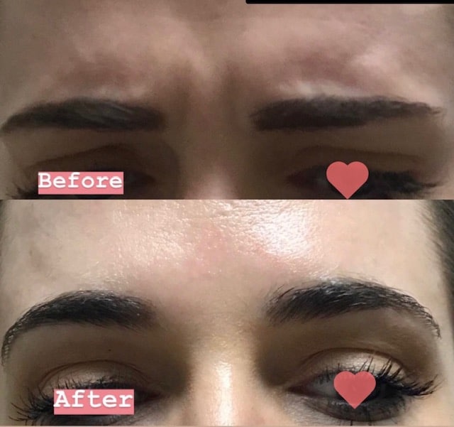 Before and After Image of Botox Austin TX