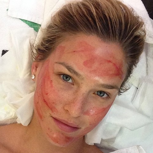 Microneedling Austin TX