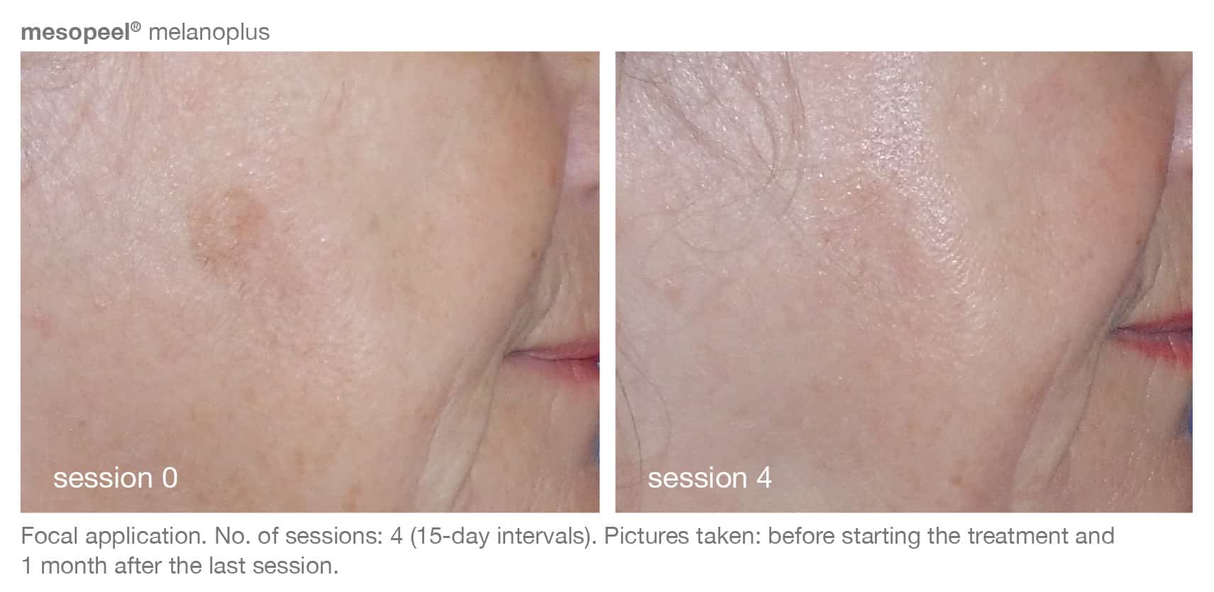 Before and After Image of Skincare Treatment Austin TX