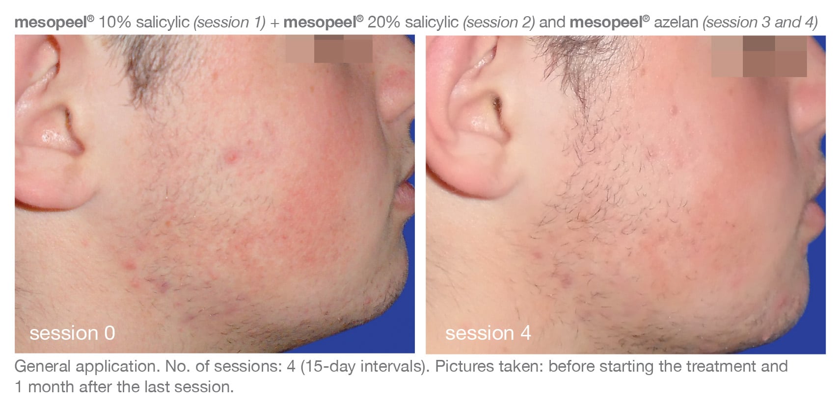 Before and After Image of Medical-grade skincare Austin TX