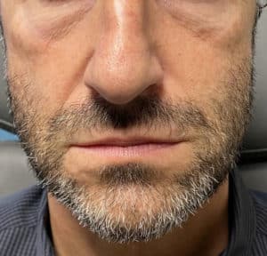 Before Image: Cosmetic Filler – Tear Trough