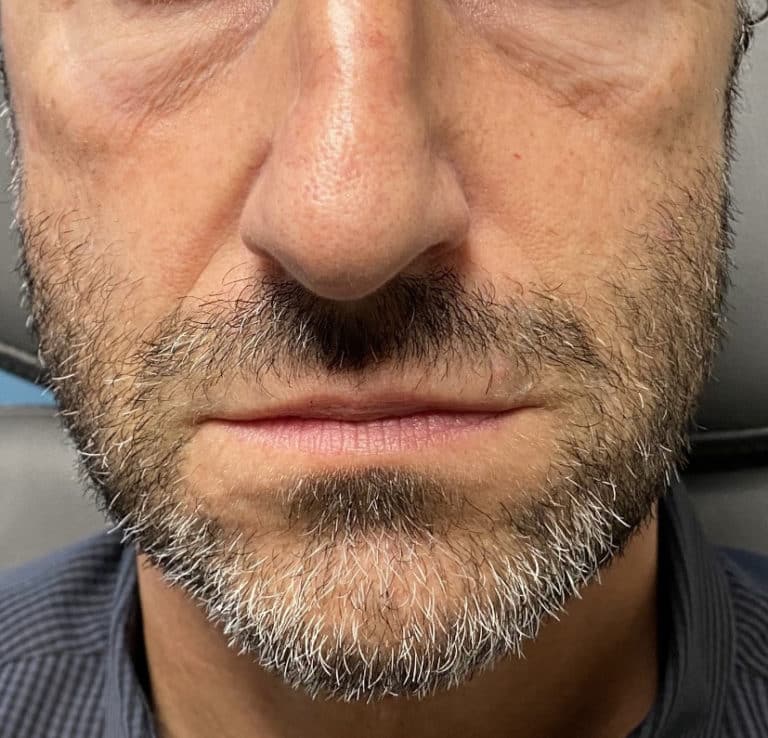 Before Image: Cosmetic Filler – Tear Trough - front