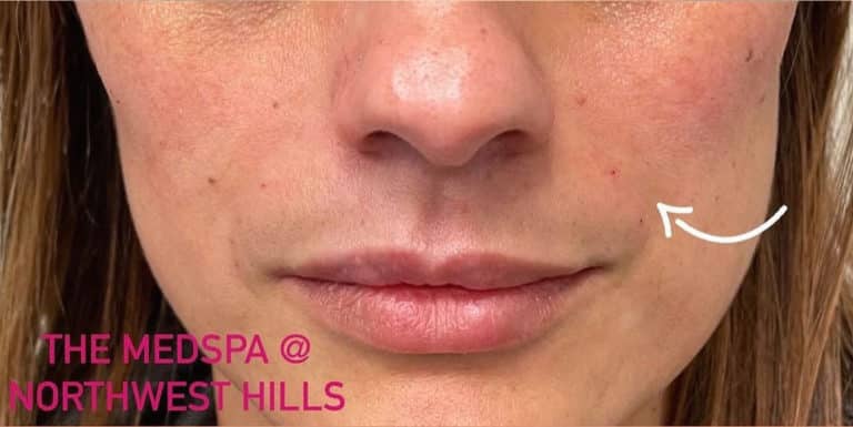 After Image: Cosmetic Filler – Nasolabial Fold - front