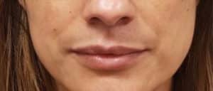 Before Image: Cosmetic Filler – Nasolabial Fold