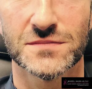 After Image: Cosmetic Filler – Tear Trough