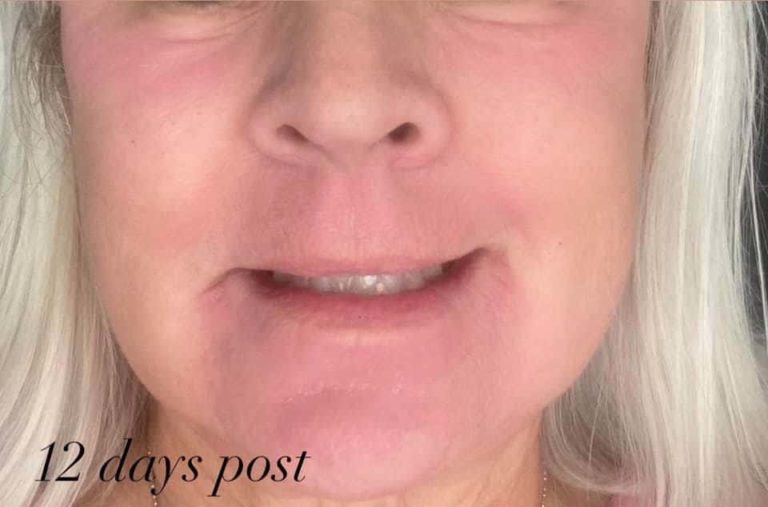 After Image: Laser Resurfacing - front