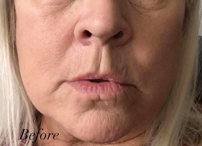 Before Image: Laser Resurfacing - front