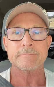 After Image: Laser Resurfacing