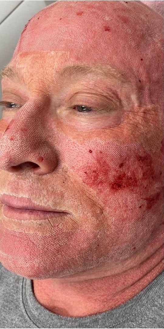 Before Image: Laser Resurfacing - front