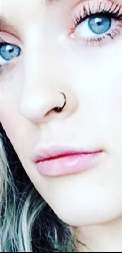 After Image: Cosmetic Filler – Lips - front