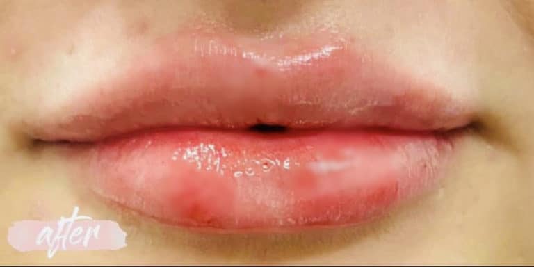 After Image: Cosmetic Filler – Lips - front