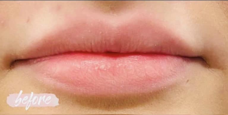 Before Image: Cosmetic Filler – Lips - front