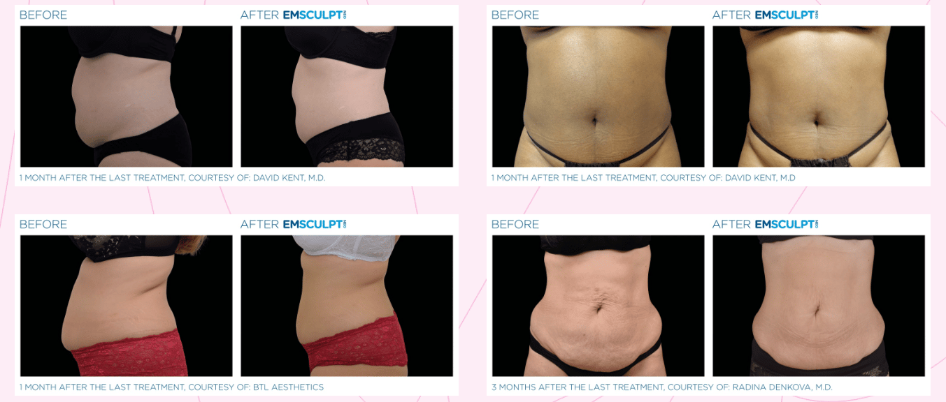Before & After Image of EMSCULPT NEO Austin TX