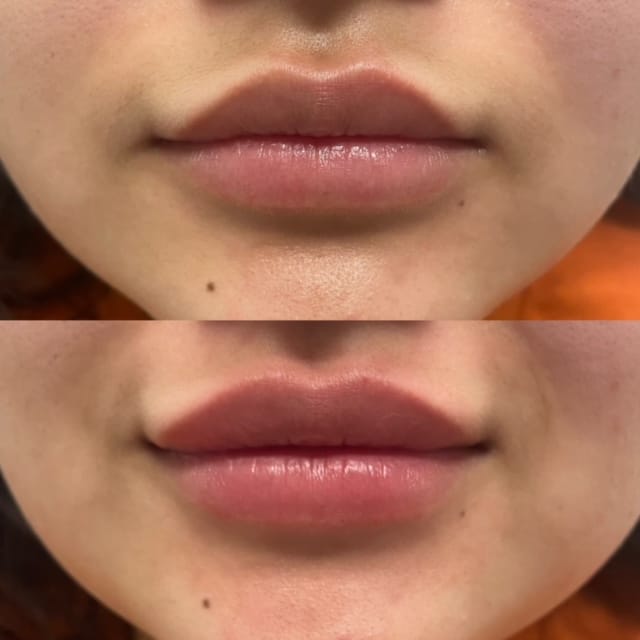 Before and After Image of Lip Fillers Westlake TX