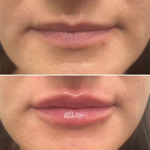 Before and After Image of Cosmetic Injectables Austin TX