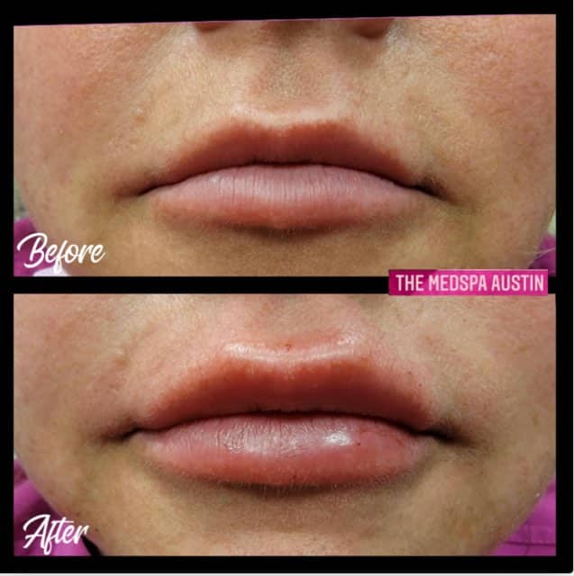 Before and After Image of Lip Fillers Treatment Austin TX