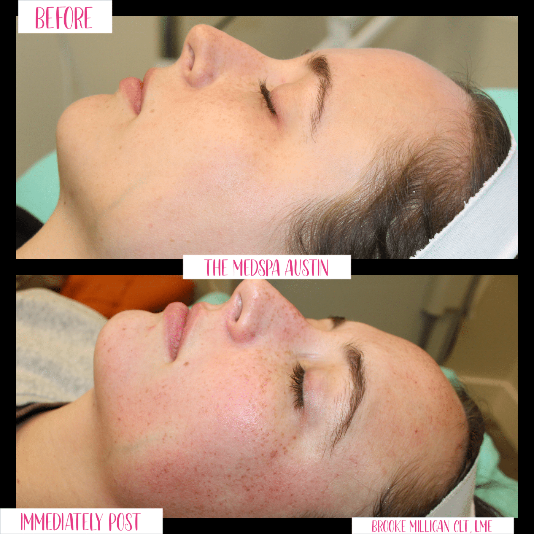 Brooke Milligan Case 1 Before and After