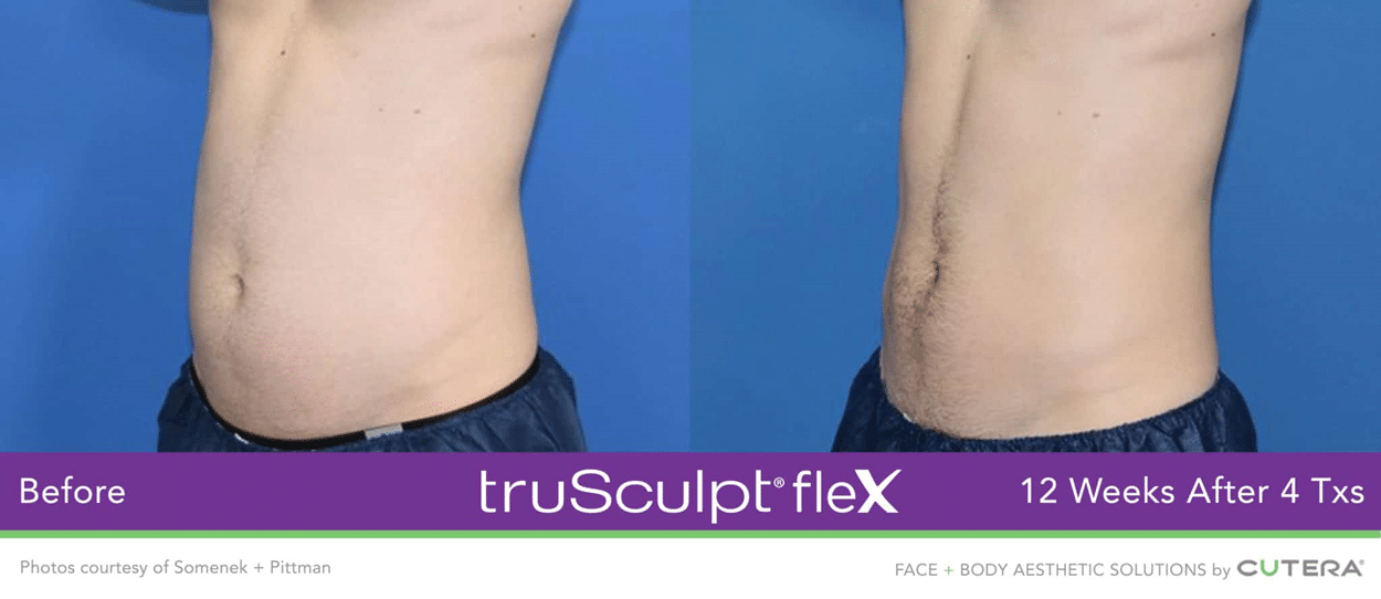 Before & After Image of TruSculpt Flex Austin TX