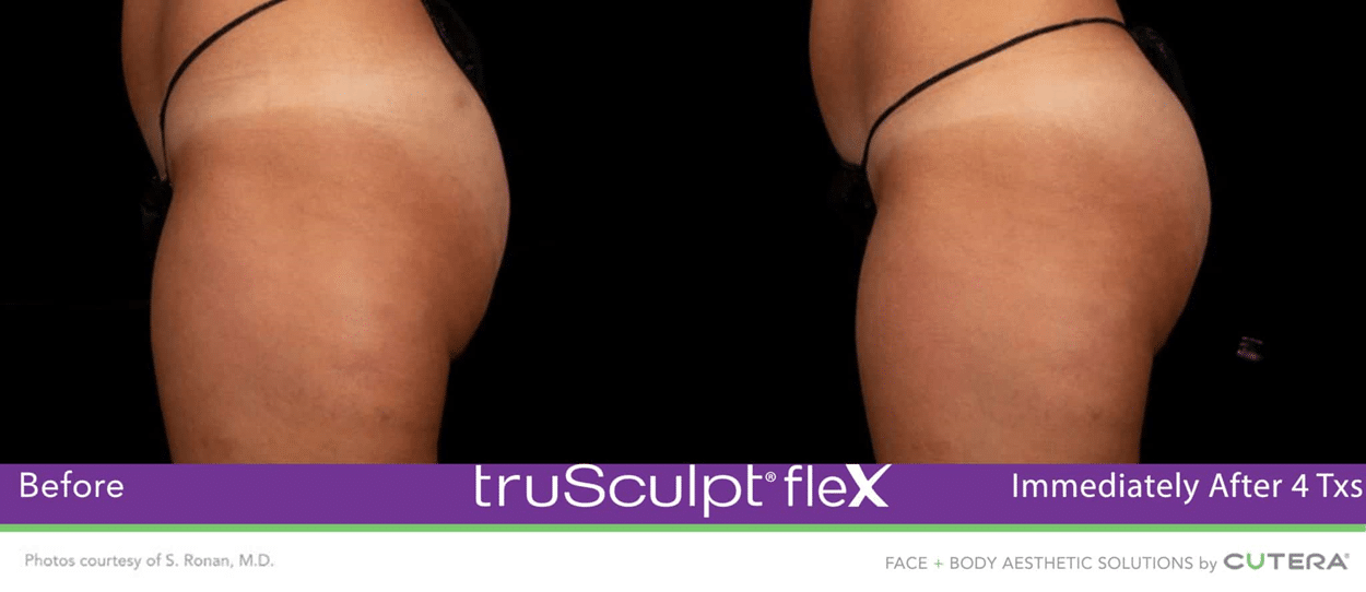 Before & After Image of Muscle Sculpting Austin TX